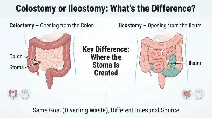 colostomy or ileostomy